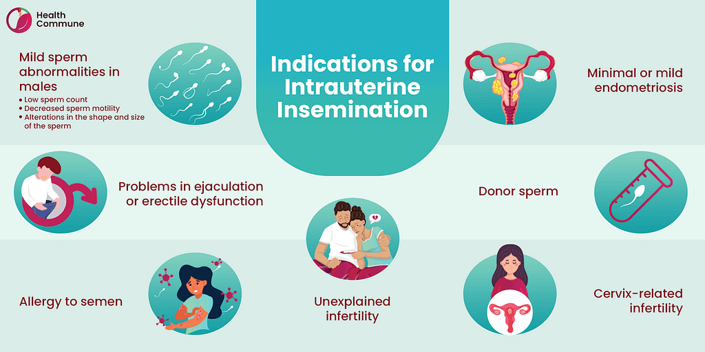 Intrauterine insemination (IUI): Facts you should know - Health Commune